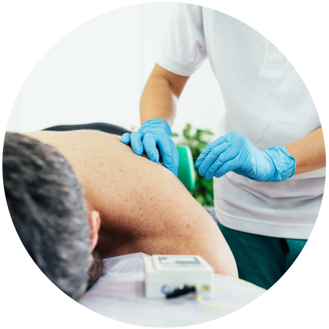 Dry Needling physical therapist Dry Needling physical therapist